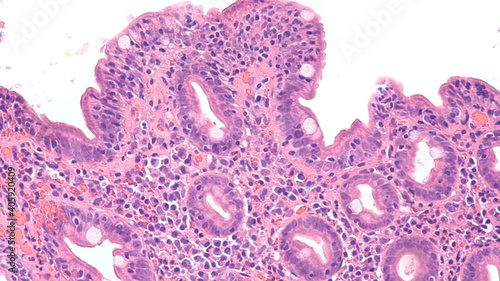 Quadro em tela Histology of duodenal biopsy from patient with bloating and diarrhea from celiac