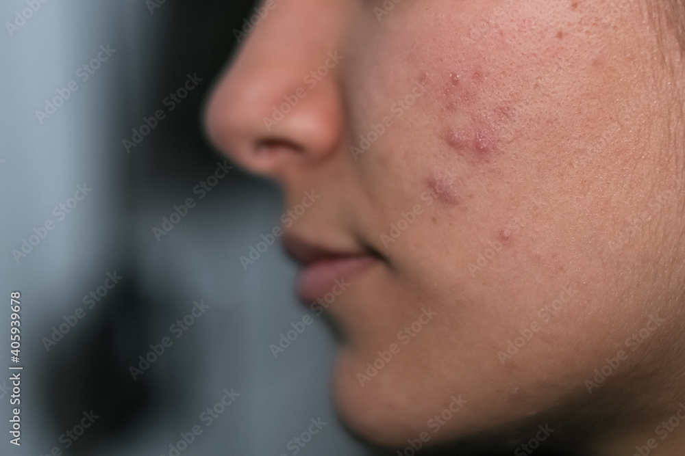Fototapeta premium Young woman with skin acne face close up view,dermatological hormone disease