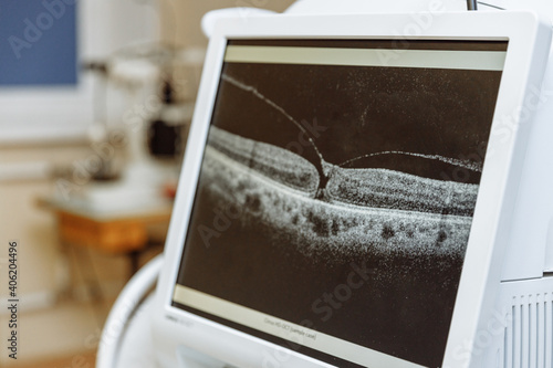 Quadro em tela Non-contact optical coherence tomograph for visualization of the anterior and posterior segments of the eyeball