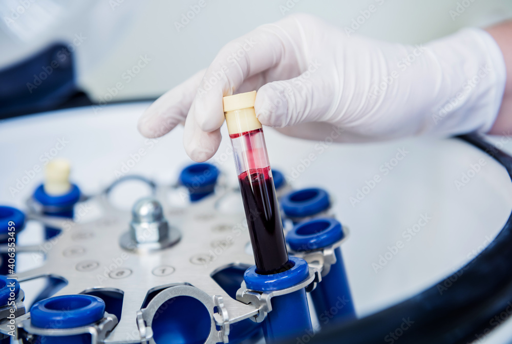 Platelet-Rich plasma preparation. Tube with blood in hands Platelet-Rich plasma preparation. Tube with blood in hands