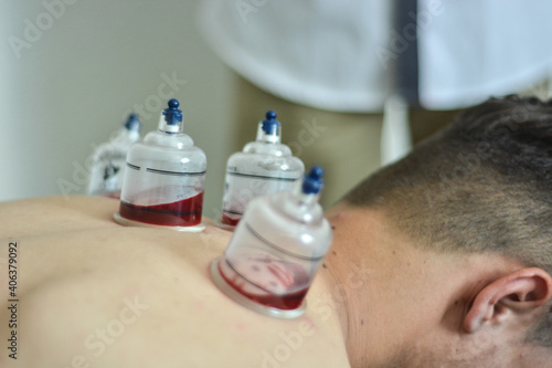 Fotografija Closeup of a young man prepared for the hijama treatment
