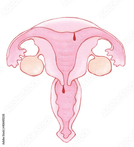 子宮頸管（内膜）ポリープ　名称ナシ photo