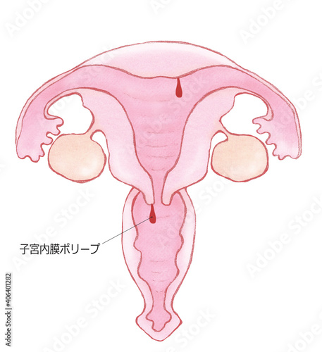 子宮頸管（内膜）ポリープ　名称あり photo