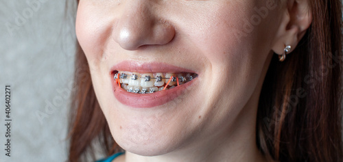 Braces on the teeth of a girl who smiles, close-up lips,