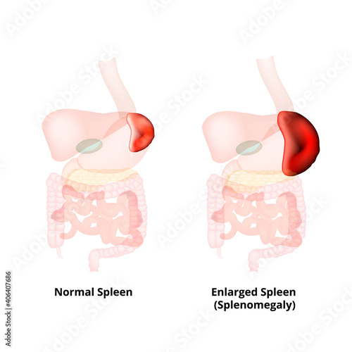 Splenomegaly of the spleen. Enlargement of the spleen. Vector illustration on isolated background