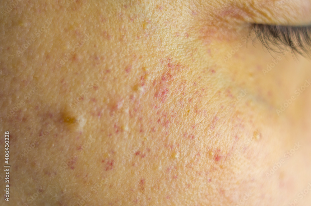Facial skin with burst capillaries due to high blood pressure. Rupture of capillary vessels on the face. Facial skin with burst capillaries due to high blood pressure. Rupture of capillary vessels on the face.