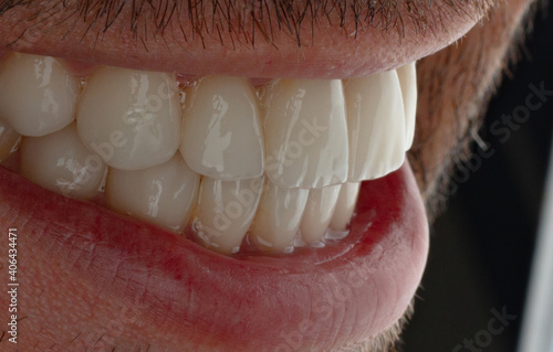 smile design with dental laminate veneers 
