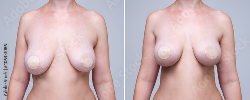 Fotografi Before and after breast augmentation concept, woman with large silicone breasts