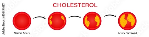 Stages cholesterol formation in erythrocytes clipart. Filling red blood cells with yellow thrombus and building up atherosclerotic vector plaques.