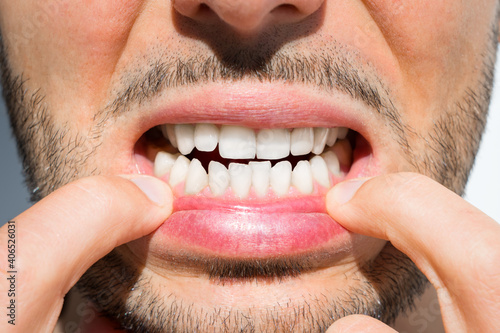 фотографія Man with crooked teeth. Reason to install teeth braces. Bad teeth