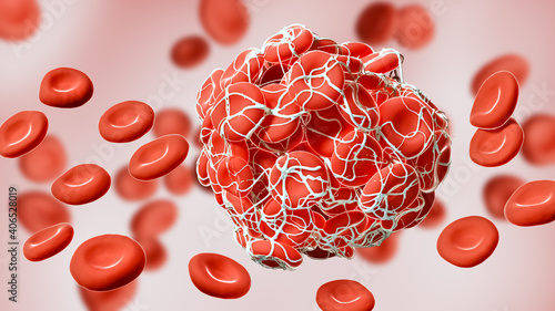 Close-up of a coagulated clot of red blood cells entangled in fibrin 3D rendering illustration. Thrombus, thrombosis, blood circulation, pathology, medical, science concepts. photo