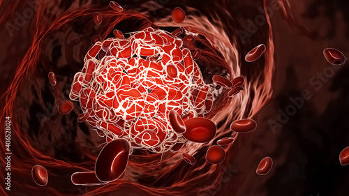 Quadro su tela Thrombus or blood clot inside a blood vessel flowing with red blood cell 3D rendering illustration