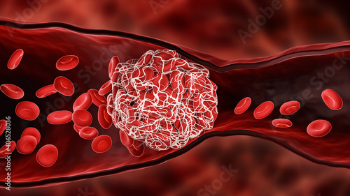 Tableau sur toile Blood Clot or thrombus blocking the red blood cells stream within an artery or a vein 3D rendering illustration