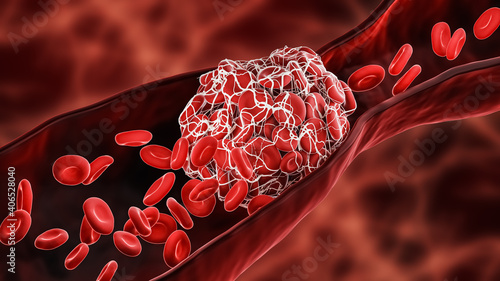 Blood Clot or thrombus blocking the red blood cells stream within an artery or a vein 3D rendering illustration. Thrombosis, cardiovascular system, medicine, biology, health, pathology concepts. photo