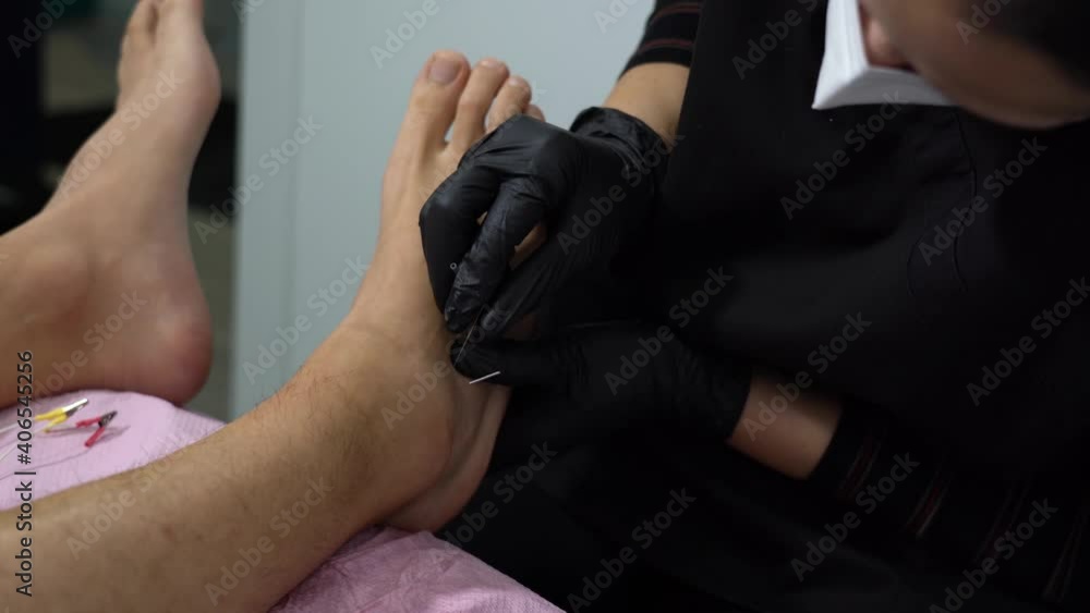 Detail of hands putting needles inside patient’s sprained ankle Stock