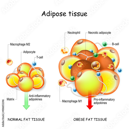 Adipocytes, obesity, and inflammation. normal, and obese adipose tissue. photo