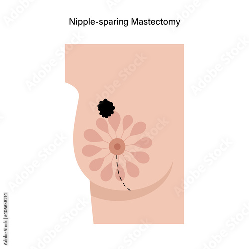 Breast disease concept