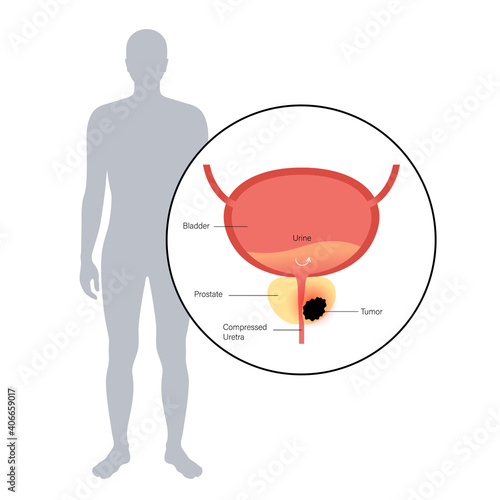 Prostate cancer concept