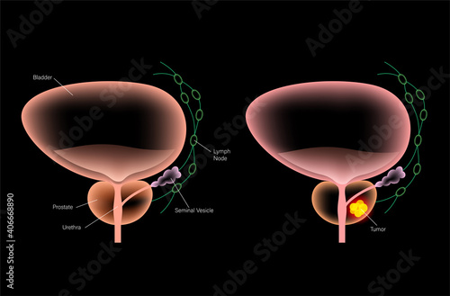Prostate cancer concept