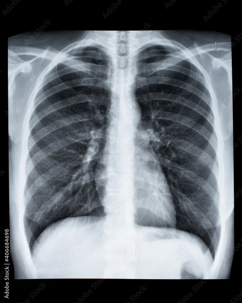 X-ray of a healthy chest, prophylactic medical checkup X-ray of a healthy chest, prophylactic medical checkup