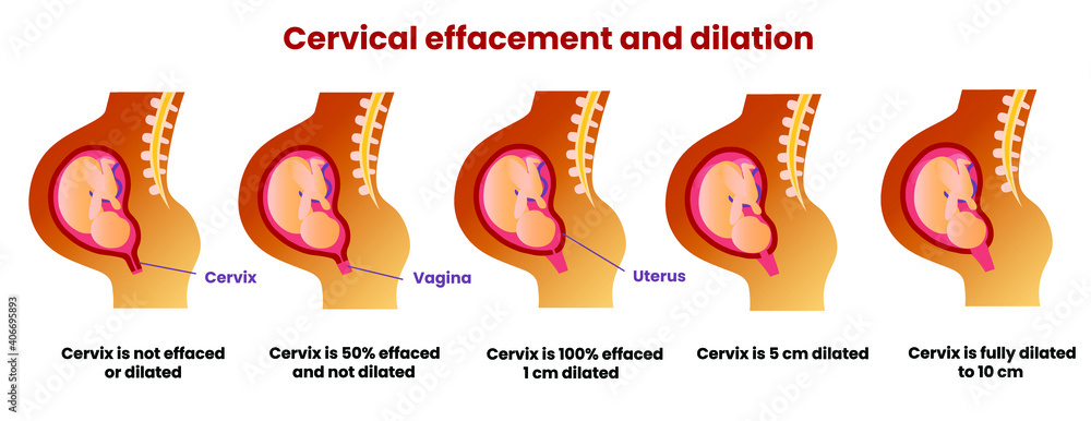 cervix dilation 10cm