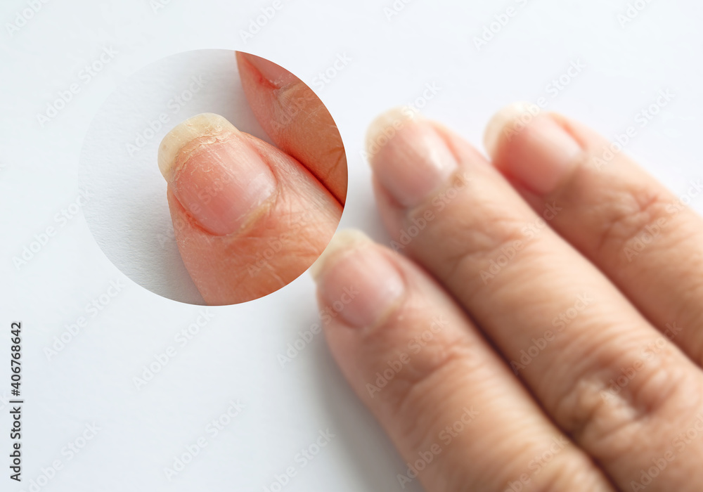Zoomin image of brittle weak dry cracked pitted woman's fingernails surface and prone to