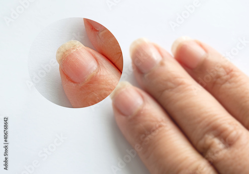 Slika na platnu Zoomin image of brittle weak dry cracked pitted woman's fingernails surface and prone to breakage caused by harsh ingredients in nail polish formulas on white background
