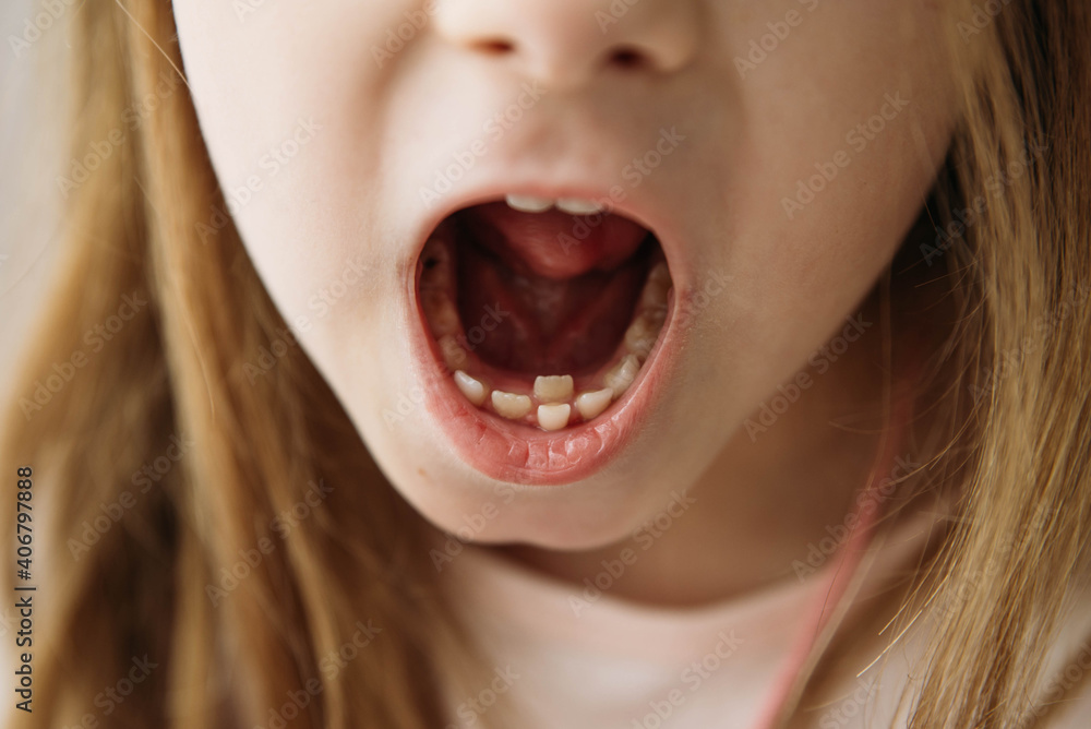 Adult permanent teeth coming in front of the child's baby teeth: shark teeth. Little girl's open mouth. Adult permanent teeth coming in front of the child's baby teeth: shark teeth. Little girl's open mouth.