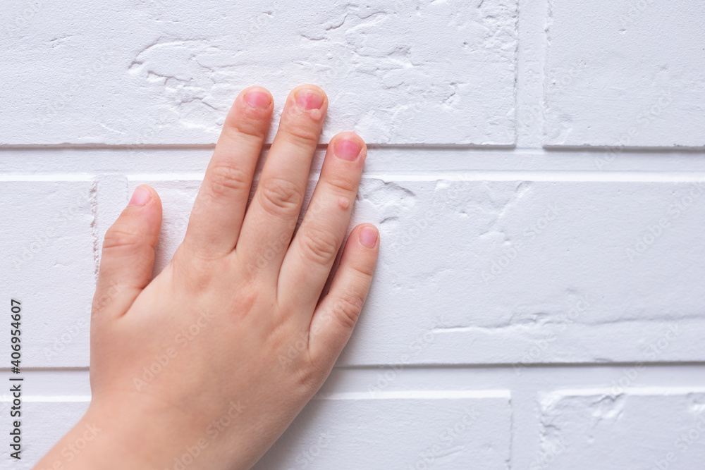 Common wart Verruca vulgaris a flat wart on the hand of children and