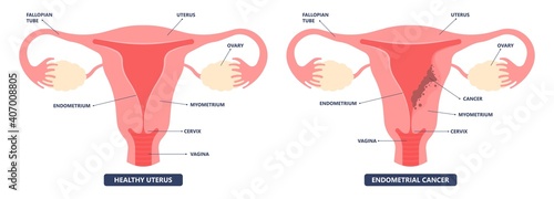 Cancer pelvic PCOS ovary Endo belly pain swelling uterus heavy ovaries cysts examine surgery remove pregnancy endobelly tube cycle period Fertility problem diagnosis menstruation cell polyp cervical
