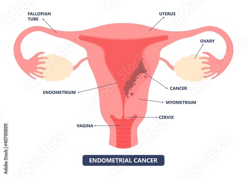 Cancer pelvic PCOS ovary Endo belly pain swelling uterus heavy ovaries cysts examine surgery remove pregnancy endobelly tube cycle period Fertility problem diagnosis menstruation cell polyp cervical