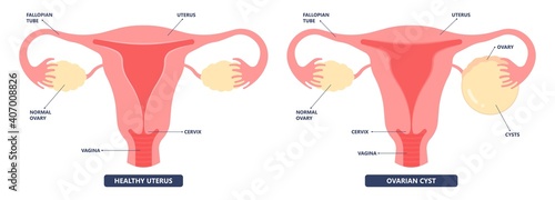 Cancer pelvic PCOS ovary Endo belly pain swelling uterus heavy ovaries cysts examine surgery remove pregnancy endobelly tube cycle period Fertility problem diagnosis menstruation cell polyp cervical