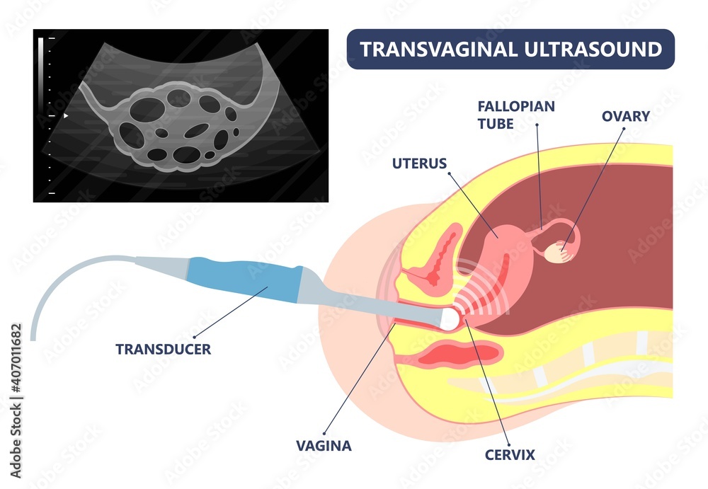Naklejka Cancer pelvic PCOS ovary Endo belly pain swelling uterus heavy