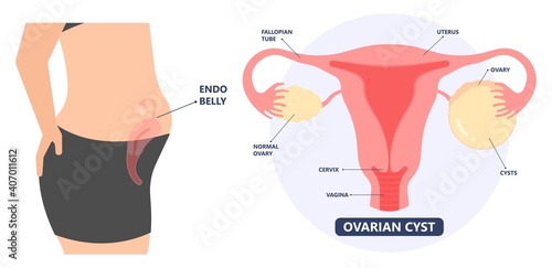 Cancer pelvic PCOS ovary Endo belly pain swelling uterus heavy ovaries cysts examine surgery remove pregnancy endobelly tube cycle period Fertility problem diagnosis menstruation cell polyp cervical