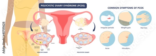 Cancer pelvic PCOS ovary Endo belly pain swelling uterus heavy ovaries cysts examine surgery remove pregnancy endobelly tube cycle period Fertility problem diagnosis menstruation cell polyp cervical