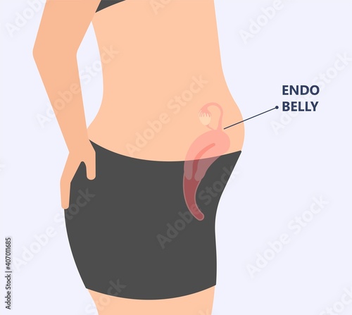 Cancer pelvic PCOS ovary Endo belly pain swelling uterus heavy ovaries cysts examine surgery remove pregnancy endobelly tube cycle period Fertility problem diagnosis menstruation cell polyp cervical