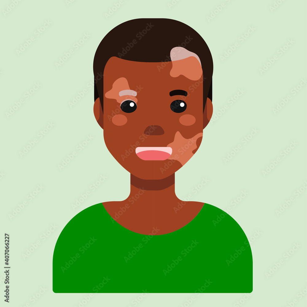 Flat cartoon vector illustration, that displays people pigmentation features. The man avatar with dark skin and vitiligo. International Day for Tolerance