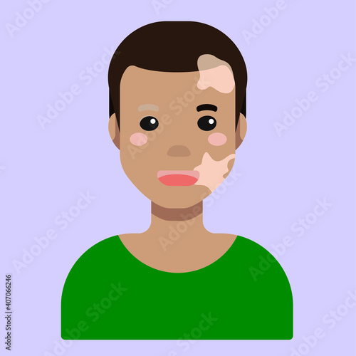 Flat cartoon vector illustration, that displays people pigmentation features. The man avatar with light skin and vitiligo. International Day for Tolerance