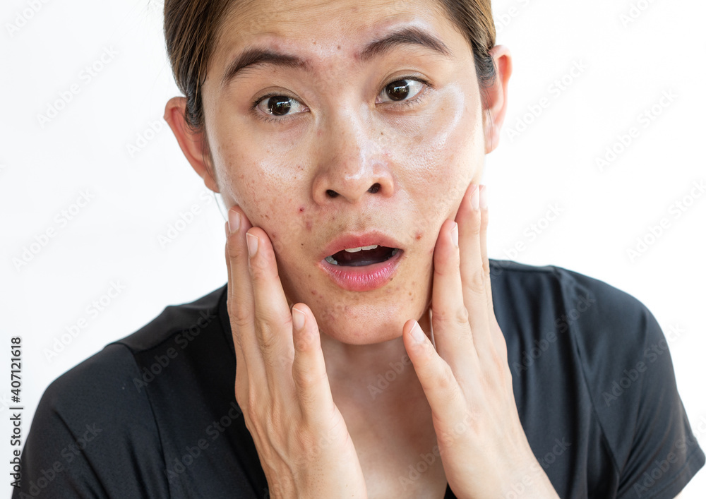 Oily skin on woman caused problems of acne inflamed on her face. Inflamed acne consists of swelling, redness, and pores that are deeply clogged with bacteria, oil, and dead skin cells. Oily skin on woman caused problems of acne inflamed on her face. Inflamed acne consists of swelling, redness, and pores that are deeply clogged with bacteria, oil, and dead skin cells.