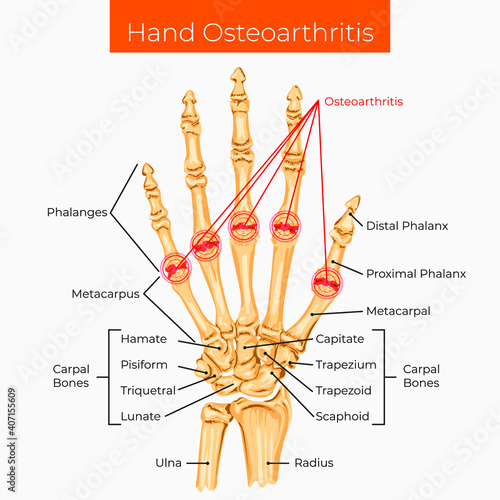Vector illustration. Hand osteoarthritis poster.