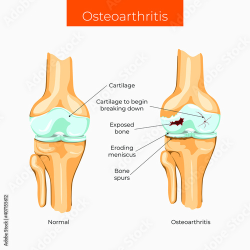 Vector illustration. Knee osteoarthritis poster.
