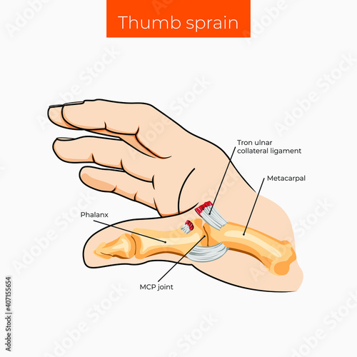 Vector illustration. Thumb sprain poster.