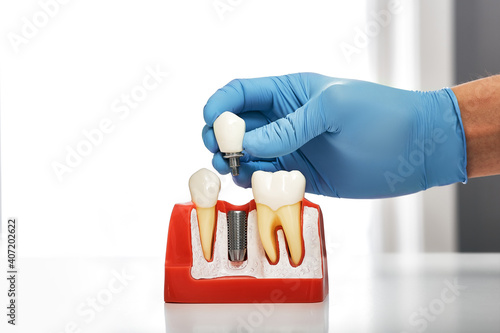 Принти на полотні Dentist showing the installation of a dental implant on the anatomical model of teeth, close-up