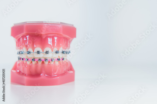 The braces are placed on the teeth in the artificial jaw on a white background. Macro photography