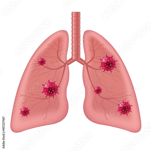 Lungs Human Internal Organ With Coronavirus Isolated White Background With Gradient Mesh, Vector Illustration