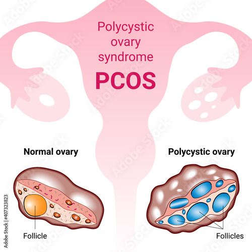 Polycystic ovary syndrome PCOS, hormonal diagnose, abnormal cancer fertility cysts. Medical vector illustration