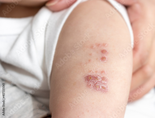 BCG注射をした赤ちゃんの腕（0歳、生後6カ月、女の子、日本人）