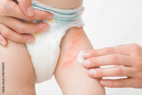 Young adult mother hand applying white medical ointment on toddler leg. Red rash on skin from diaper. Care about baby body. Closeup. Front view. Isolated on light gray background.