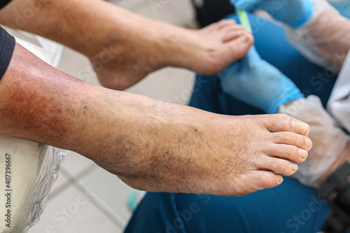 Schilderij op canvas Leg vein disease, dark spots on the skin of the legs, treatment, examination of toenails, fungus