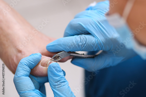 The doctor removes a toenail infection and disease, inflammation. Clinic, instruments, sterile.